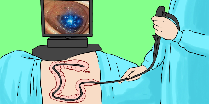 colonoscopy