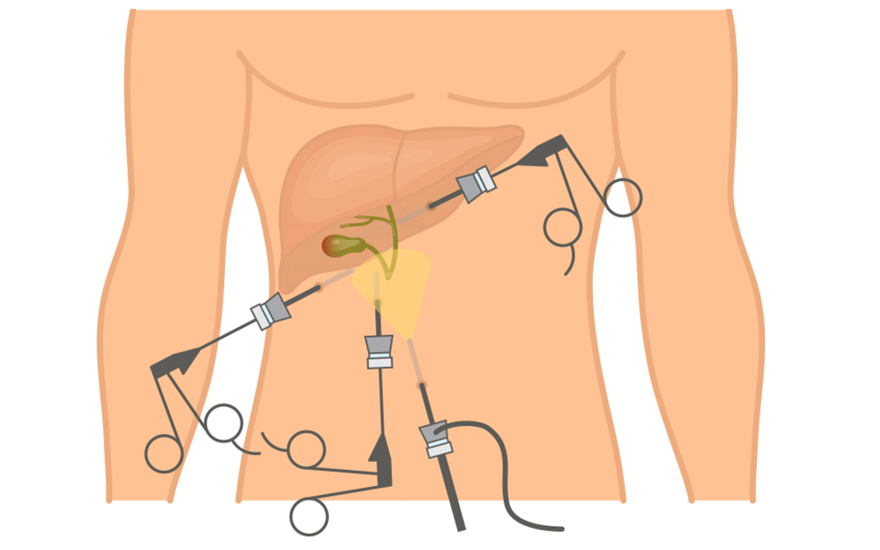  Laparoscopic-Cholecystectomy-Treatment