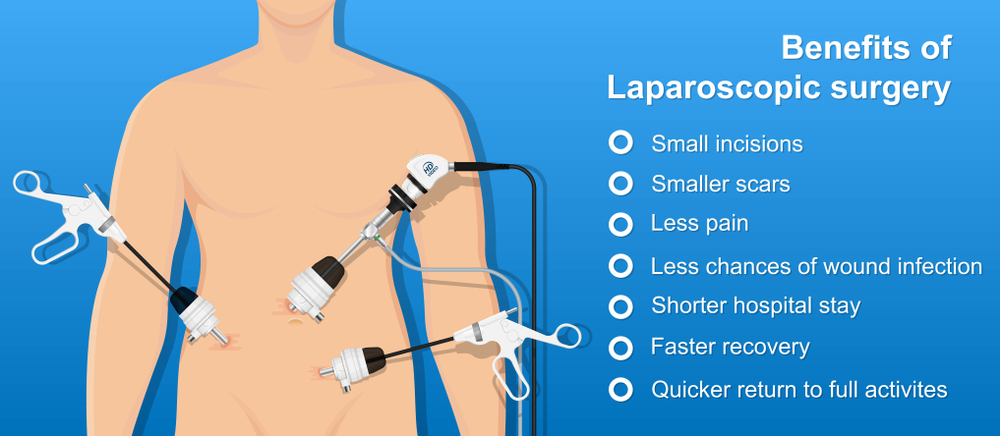 The Benefits of Laparoscopic Surgery