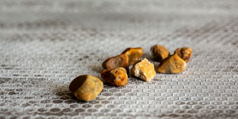 gallstones