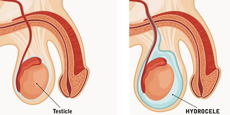 hydrocele