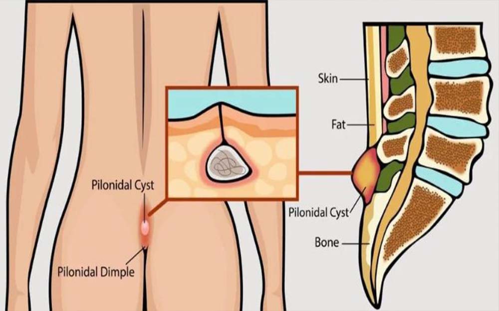 Importance of Early Treatment of Anal Fissures