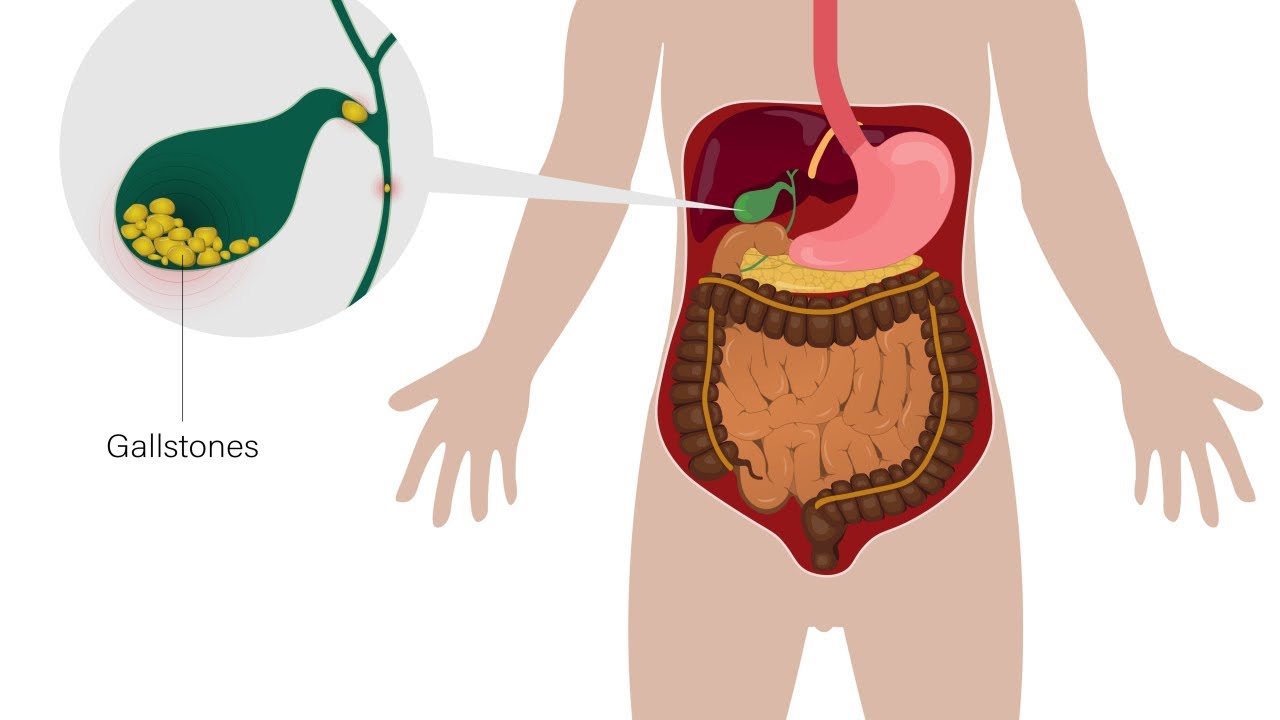  Laparoscopic-Cholecystectomy-Treatment