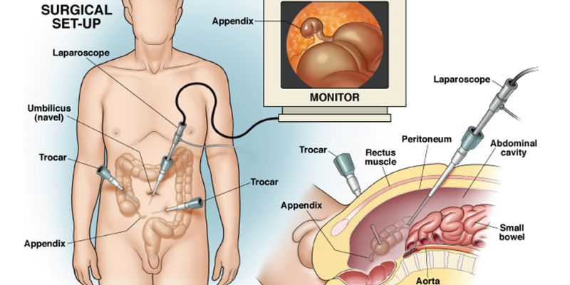 laparoscopic-appendicectomy