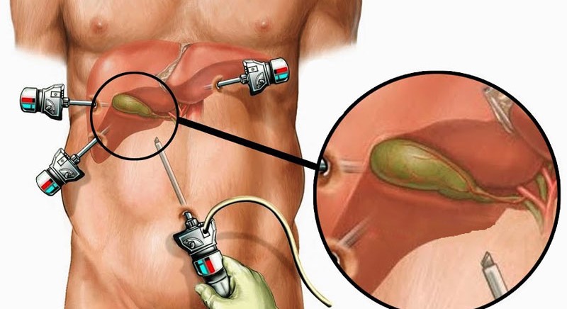 What is Laparoscopic Cholecystectomy?