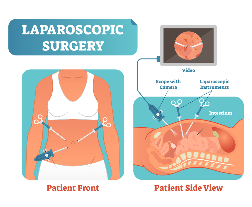 Laparoscopic Surgery