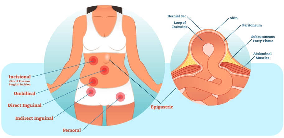 Types of Hernias